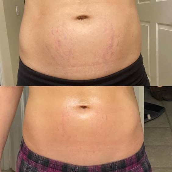 Pregnancy Stretch Marks Cream - Heal & Repair